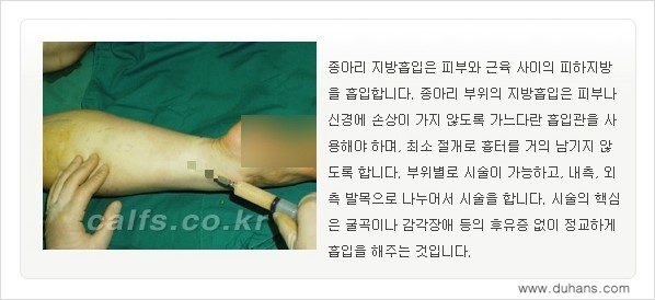 [두한성형외과 경쟁력 종아리성형] - [종아리 지방흡입 1.] 관련 이미지 7