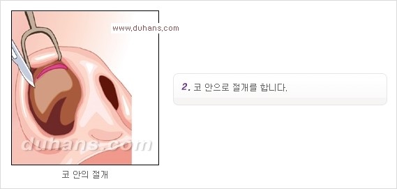 [두한성형외과 경쟁력 코성형] - [코성형을 위한 알로덤(슈어덤) 수술, 실리콘 수술 안내] 관련 이미지 20