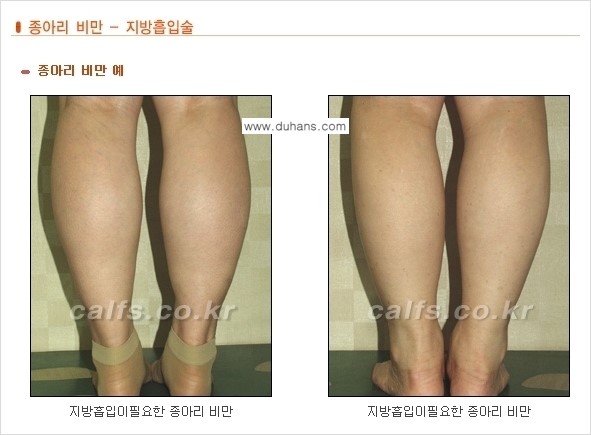 [두한성형외과 날씬한 종아리 만들기!] - [종아리 성형 안내 2.] 관련 이미지 2