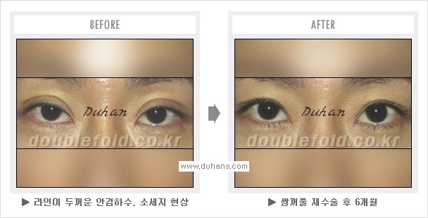 [두한성형외과 경쟁력 쌍꺼풀 재수술, 극한 눈재수술] - [두툼한 소세지 쌍꺼풀 라인 교정] 관련 이미지 7