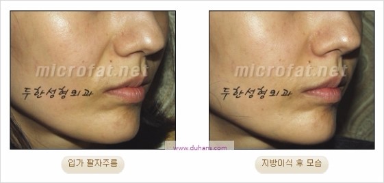[두한성형외과 경쟁력 주름성형] - [젊어 보이는 입가팔자주름 지방이식] 관련 이미지 17