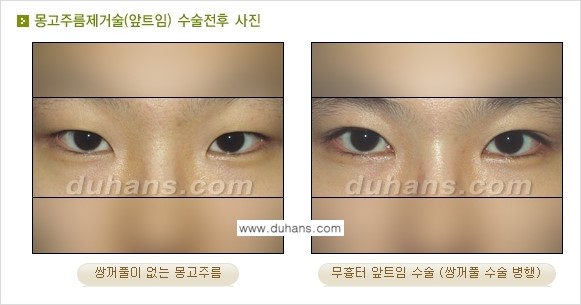 [두한성형외과 눈성형 FOCUS] - [몽고주름 제거(앞트임 제거) 수술 ③] 관련 이미지 4