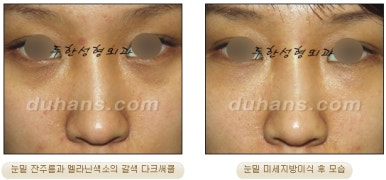 두한성형외과 눈밑성형 - 눈밑지방제거, 눈밑주름, 눈밑지방재배치 관련 이미지 71