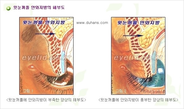 [두한성형외과 경쟁력 미세지방이식] - [꺼진(함몰된) 윗눈꺼풀 미세지방이식] 관련 이미지 2