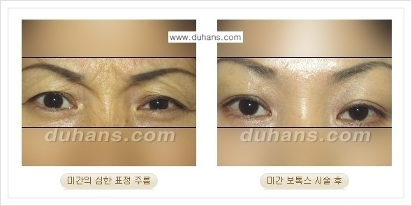 [두한성형외과 경쟁력 주름성형] - [얼굴 주름제거 보톡스 안내] 관련 이미지 6