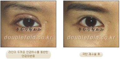 쌍꺼풀수술 두한성형외과 - 쌍커풀재수술의 문제점 관련 이미지 31