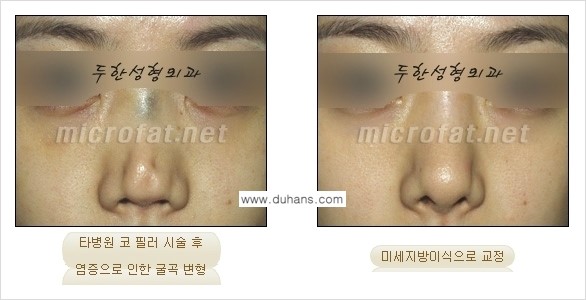 [두한성형외과 경쟁력 코성형] - [미세지방이식을 이용한 자연스러운 코성형 안내] 관련 이미지 20