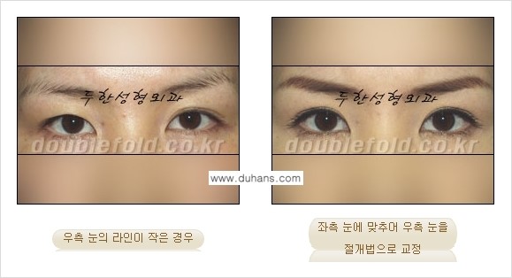 [두한성형외과 경쟁력 쌍꺼풀 재수술] - [비대칭(짝짝이) 쌍꺼풀 라인 교정하는 방법 안내 ①] 관련 이미지 6