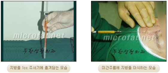 Duhan Plastic Surgery Wrinkle Improvement - Glabellar Horizontal Wrinkles, Glabellar Straight Wrinkles, Glabellar Wrinkle Surgery image 6