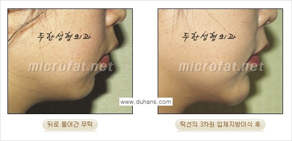 [두한성형외과의 경쟁력 미세지방이식] - [무턱교정 - 턱 미세지방이식 안내 2.] 관련 이미지 21