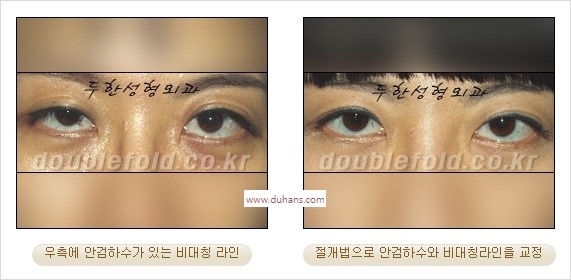 ⁠⁠[두한성형외과 경﻿쟁력 쌍꺼풀 재수술] - [안검하수(졸리운 눈매) 종류와 교정 방법 안내] 관련 이미지 25