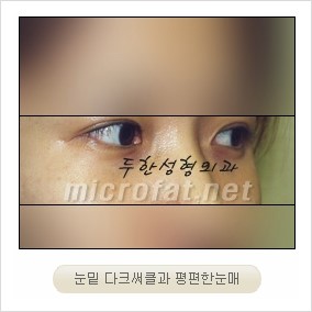 ​﻿[두한성형외과 경쟁력 지방이식] - [눈밑 애교살 시술을 위한 미세지방이식] 관련 이미지 2
