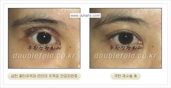 [두한성형외과 경쟁력 쌍꺼풀 재수술] - [극한의 상태에서 쌍꺼풀 재수술 안내 ①] 관련 이미지 13