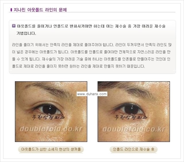 [두한성형외과 경쟁력 쌍꺼풀 재수술(극한 재수술)] - [쌍꺼풀 재수술에서 극복해야 할 여러 가지 상황과 문제점들 안내] 관련 이미지 4