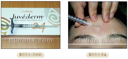Duhan Plastic Surgery Wrinkle Improvement - Wrinkle Fillers, Juvederm image 2