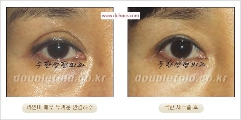 ​[두한성형외과 눈재수술] - [앞트임복원, 뒤트임복원, 쌍꺼풀복원] 관련 이미지 40