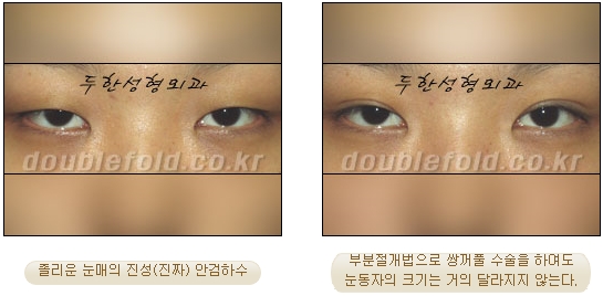 [Duhan Plastic Surgery Double Eyelid Revision Surgery] - [Ptosis, sausage eyelids] image 3