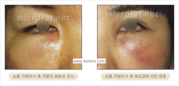 [두한성형외과 "미세지방이식"] - [지방이식 부작용 교정 정보 ①] 관련 이미지 10