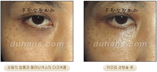 [Duhan Plastic Surgery Ophthalmic Plastic Surgery] - [Lower Blepharoplasty] image 25