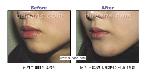 [두한성형외과 경쟁력 미세지방이식] - [아름다운 얼굴선 - 무턱, 오목턱, 비대칭턱 지방이식 안내] 관련 이미지 9