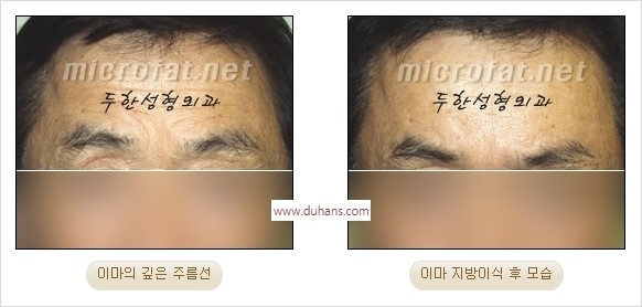 [두한성형외과 경쟁력 동안성형 리더] - ​[미간주름, 이마주름, 안검성형, 이마거상술, 눈썹거상술] 관련 이미지 35
