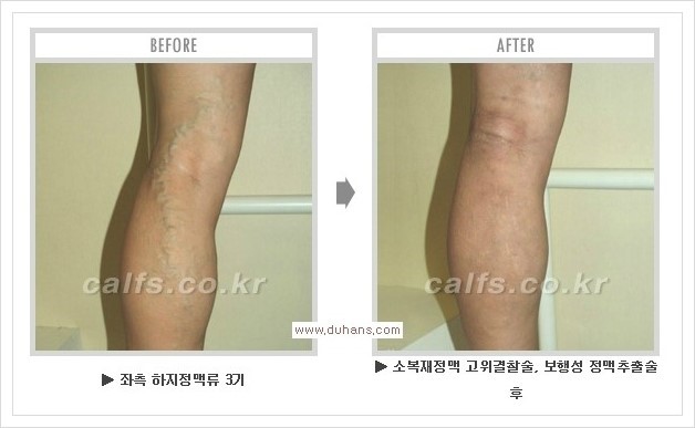 [두한성형외과 경쟁력 멀티종아리성형] - [종아리성형 방법별 전후 주의사항] 관련 이미지 41