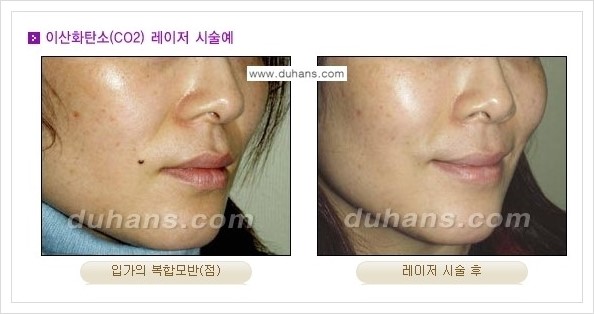 [두한성형외과 경쟁력 레이저시술] - [이산화탄소 점제거 안내] 관련 이미지 8