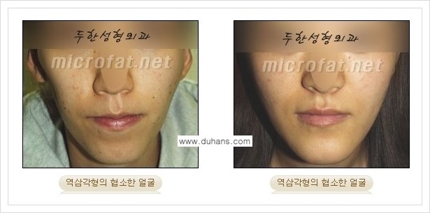 ⁠⁠[두한성형외과 경쟁력 볼살지방이식] - [심하게 야윈 주름이 있는 얼굴, 역삼각형 협소한 얼굴, 광대뼈가 돌출되어 보이는 경우 안내] 관련 이미지 3