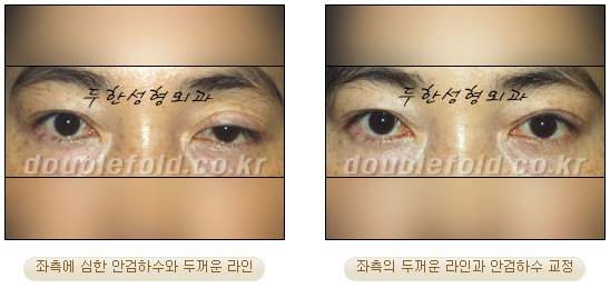 [Duhan Plastic Surgery Double Eyelid Revision Surgery] - [Ptosis Correction Surgery] image 46