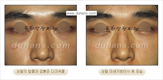 [두한성형외과 경쟁력 미세지방이식] - [다크써클 & 눈밑주름 미세지방이식 4.] 관련 이미지 7