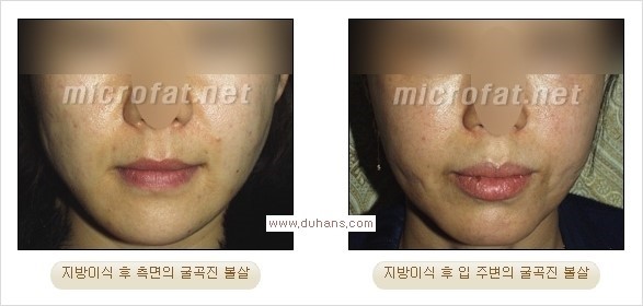 [두한성형외과 경쟁력 미세지방이식] - [지방이식에 대한 잘못된 정보와 부작용 없는 지방이식 시술 방법 안내] 관련 이미지 22