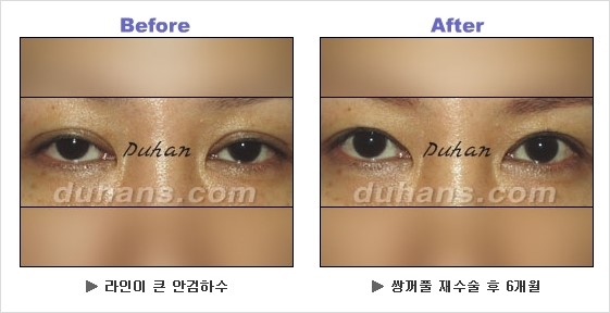 [두한성형외과 경쟁력 쌍꺼풀 재수술] - [안검하수 성형 흔한 질문과 답변 모음] 관련 이미지 6