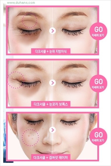 [두한성형외과 Dr. 컬럼] - [눈밑 다크써클 치료의 효과] 관련 이미지 8