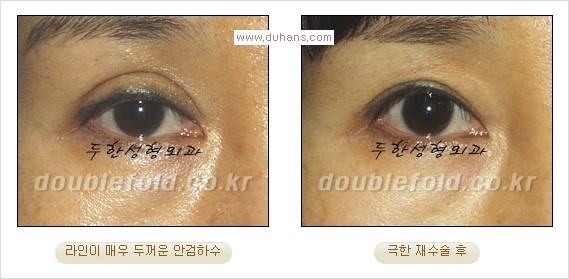 [두한성형외과 경쟁력 쌍꺼풀 재수술, 극한 재수술]- [쌍꺼풀 재수술의 성공 조건(Condition of successful reoperation) 관련 이미지 17