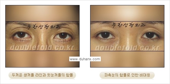 [두한성형외과 경쟁력 눈성형] - [ #꺼진눈꺼풀성형 #함몰눈꺼풀 의 쌍꺼풀 라인의 교정 안내 ②] 관련 이미지 2