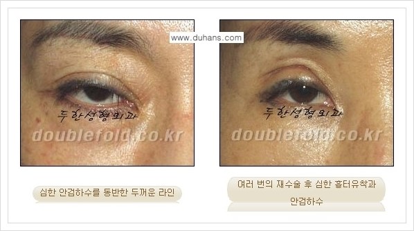 [두한성형외과 경쟁력 쌍꺼풀 재수술] - [극한의 상태에서 쌍꺼풀 재수술 안내 ①] 관련 이미지 2