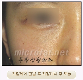 [두한성형외과 지방이식] - [다크써클, 눈​밑주름] 관련 이미지 43