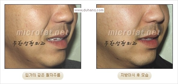 [두한성형외과 경쟁력 주름성형] - [코 옆과 입가에 걸쳐서 형성된 주름을 교정해주는 미세지방이식] 관련 이미지 10