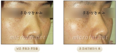Fat Grafting Leader Duhan Plastic Surgery - Everything About Fat Grafting image 11