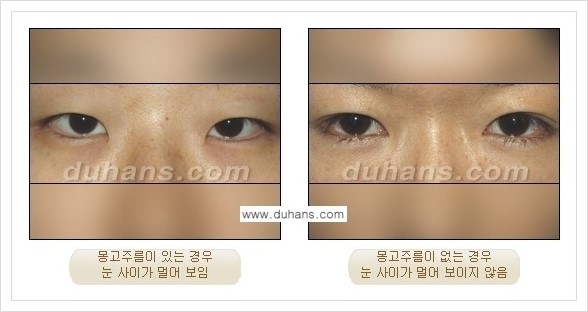 [두한성형외과 경쟁력 눈성형] - [앞트임 수술(몽고주름 제거) 안내 ①] 관련 이미지 1
