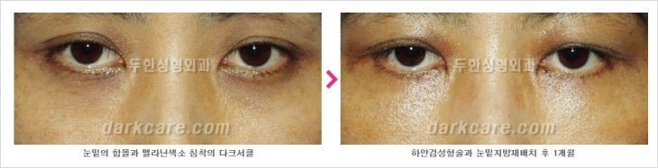 ​[두한성형외과 경쟁력 눈밑성형 리더] - [눈밑 다크써클의 증상, 원인, 종류, 치료방법 안내] 관련 이미지 73