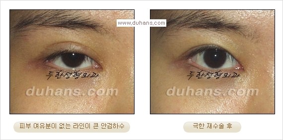 [두한성형외과 경쟁력 눈성형] - [Dr. 컬럼  "어떤 쌍꺼풀이 아름다운 쌍꺼풀인가?!] 관련 이미지 4