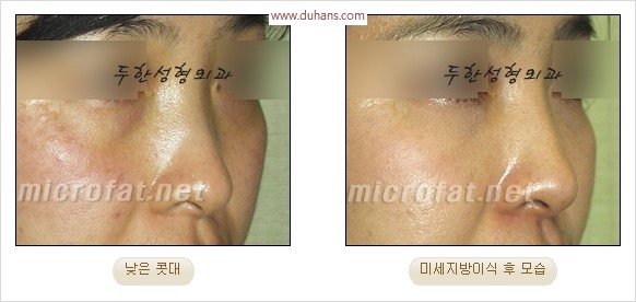[두한성형외과 경쟁력 코성형 리더] - [자연스럽고 오똑한 콧망울! 코성형 방법]​ 관련 이미지 55
