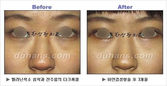 [두한성형외과 경쟁력 동안성형 리더] - ​[미간주름, 이마주름, 안검성형, 이마거상술, 눈썹거상술] 관련 이미지 122