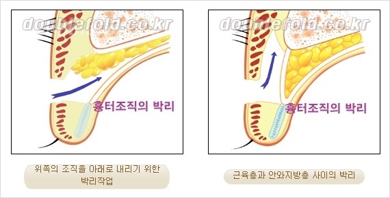[두한성형외과 경쟁력 눈성형] - [쌍꺼풀 재수술에 대한 최선의 대안 제시] 관련 이미지 8