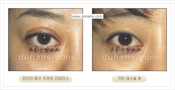 [두한성형외과 경쟁력 망가진 눈 복원수술] - [두꺼운 라인을 교정하는 극한 재수술(Extreme Reoperation) 안내] 관련 이미지 3