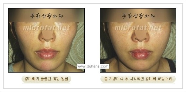⁠⁠[두한성형외과 경쟁력 볼살지방이식] - [심하게 야윈 주름이 있는 얼굴, 역삼각형 협소한 얼굴, 광대뼈가 돌출되어 보이는 경우 안내] 관련 이미지 18