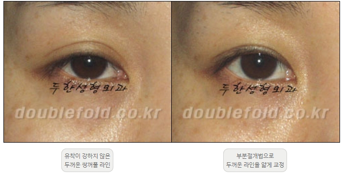 [Duhan Plastic Surgery Double Eyelid Revision] - [Thick Double Eyelid Line] image 30