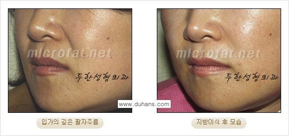 [두한성형외과의 경쟁력 있는 지방이식] - [입가주름, 팔자주름 미세지방이식 1.] 관련 이미지 9