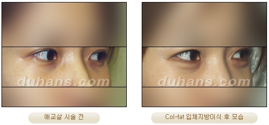 [Duhan Plastic Surgery Facial Autologous Fat Grafting] - [Fat Grafting Guide] image 24